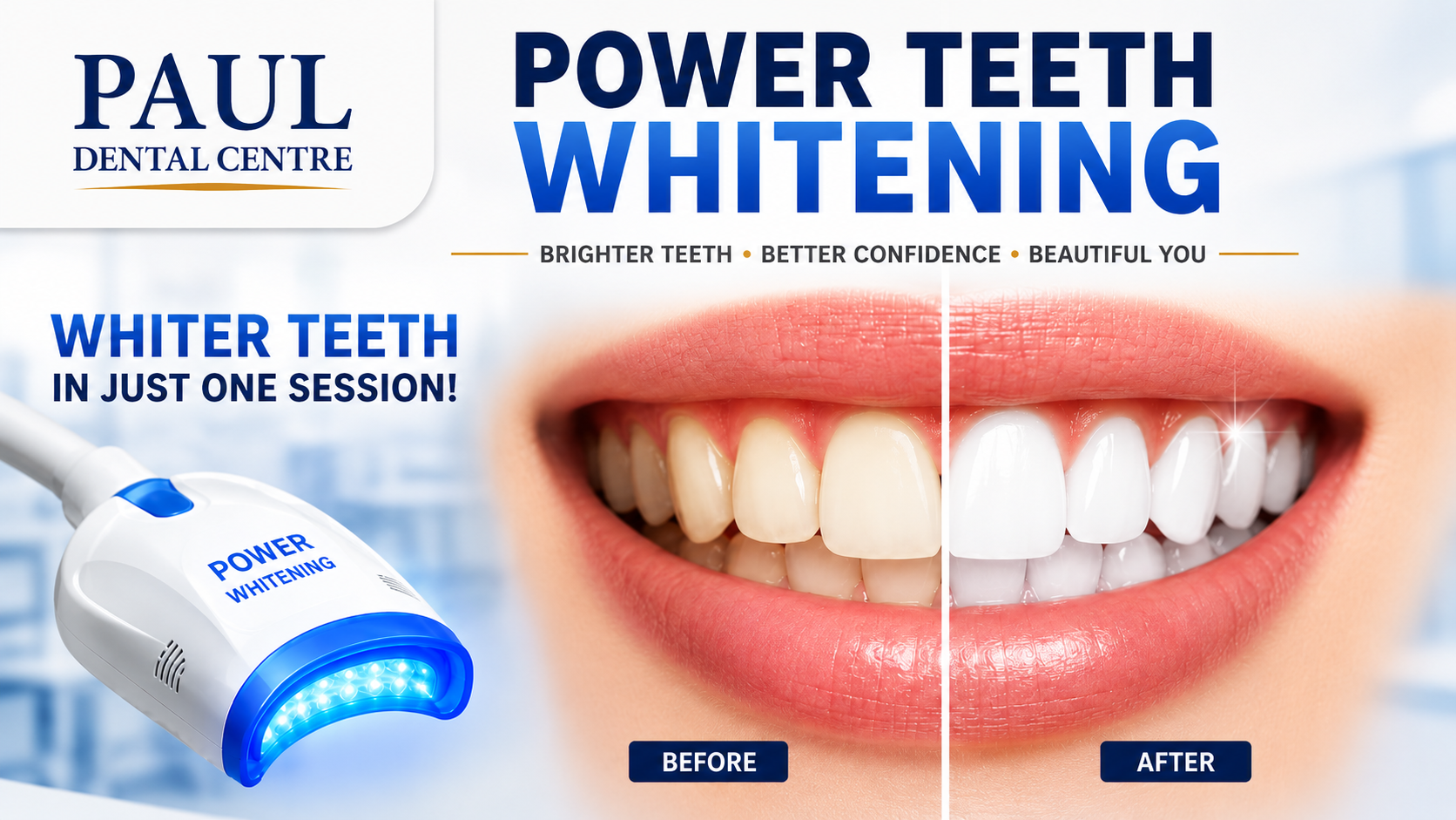Professional Teeth Whitening